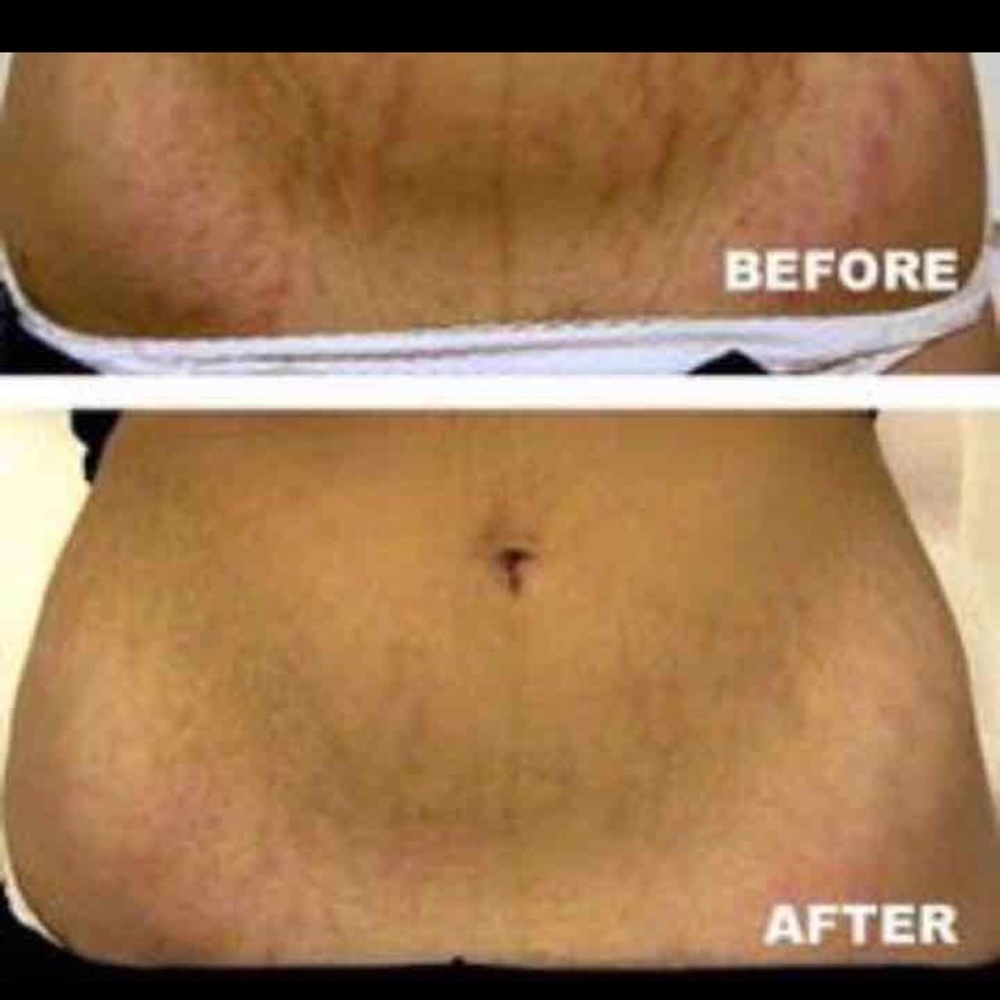🎉Cellulite and Stretch mark lightening spa soap! Several repeat buyers!